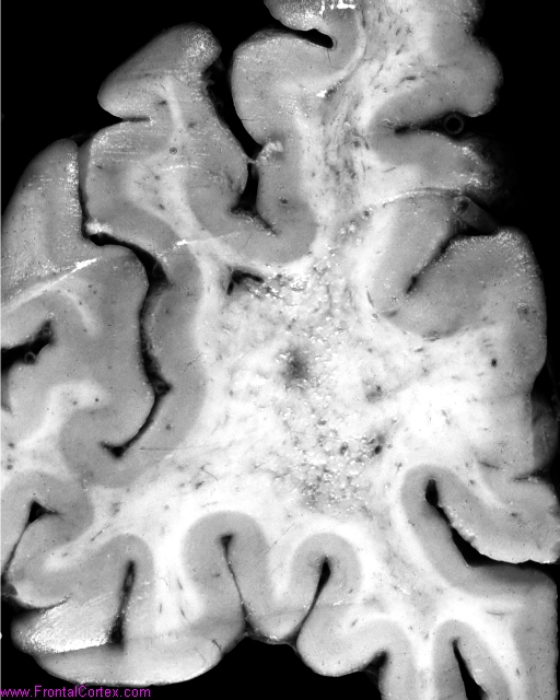 Binswanger's subcortical arteriosclerotic encephalopathy